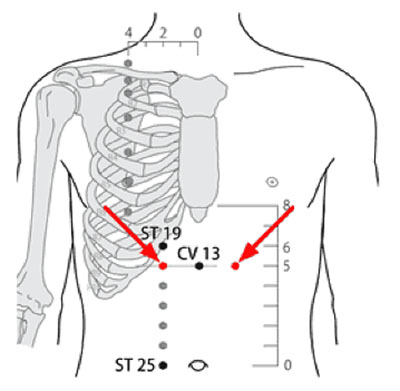 承滿穴→治胃痛、胃痙攣
