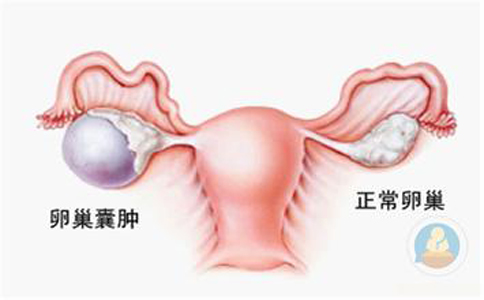 卵巢囊腫，抱腿壓涌泉穴，給你愛心呵護