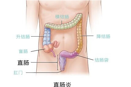 瘍潰瘍性結腸炎的拔罐療法