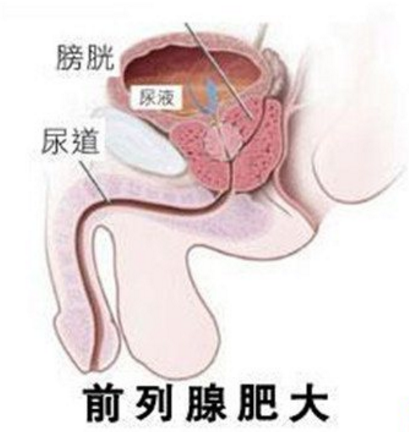 前列腺肥大