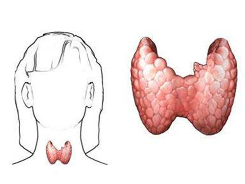 治療地方性甲狀膿腫
